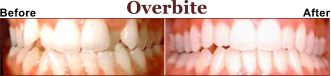 Need Help With Your Overbite?