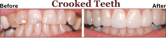 Helped Thousands of Patients fix Their Crooked Teeth.